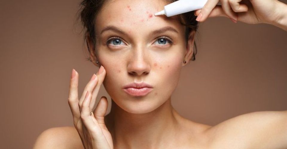 Wanita Berjerawat (Pinterest: affderm.com)