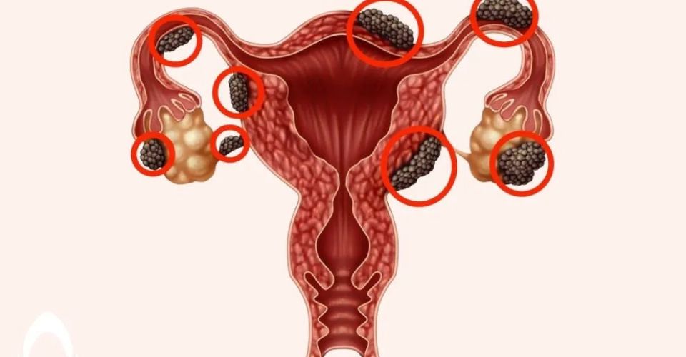 FOTO: endometriosis (sumber: Bocah Indonesia)